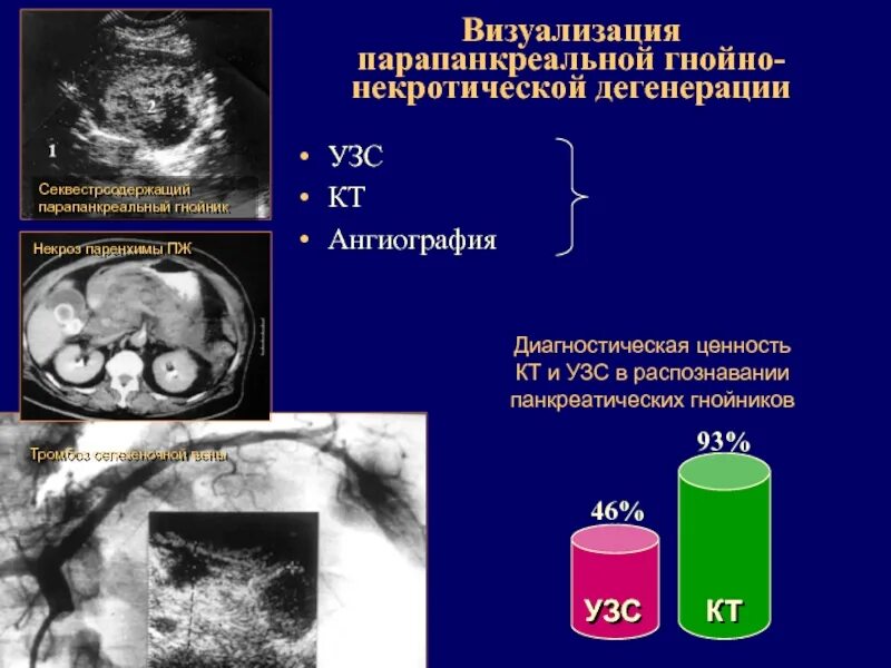 Гнойно-септические осложнения острого панкреонекроза. Форма острова панкреатит. Послеоперационные осложнения острого панкреатита. Классификация панкреонекроза. Панкреонекроз макропрепарат.