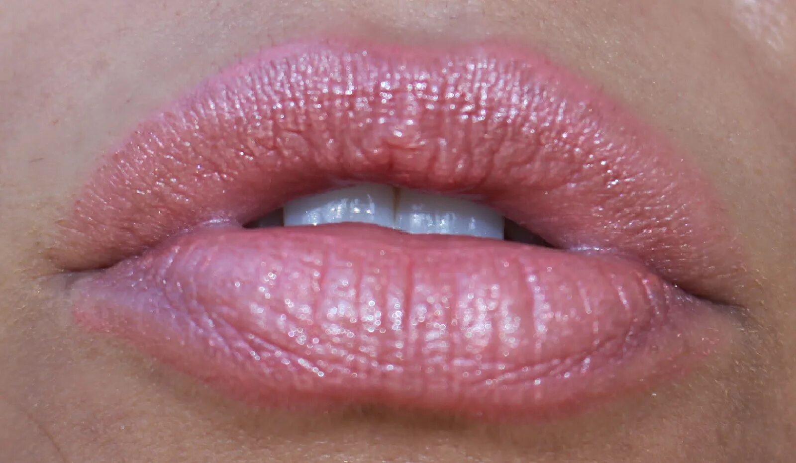 Гиповитаминозный хейлит. Периоральный (пероральный) дерматит. От поцелуя раздражение. Стрептодермия носогубный треугольник. Фото поцелуя в губы.