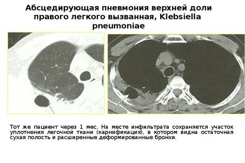 Участок легочной ткани