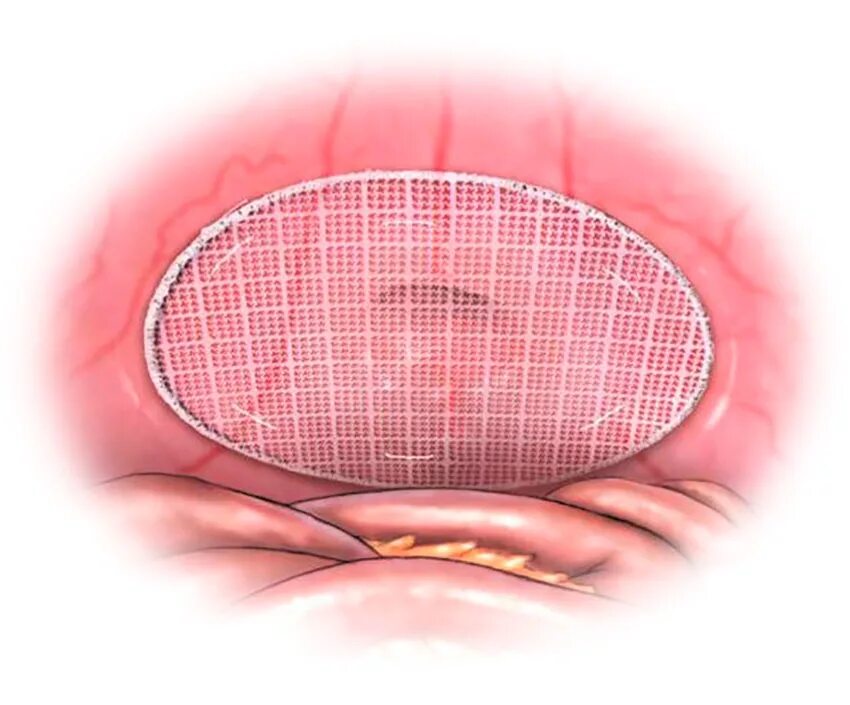 Сетчатый эндопротез sublay. Сетчатый эндопротез для пупочной грыжи. Сетчатый имплант для грыжи пупочной. Сетка для операции на грыжу