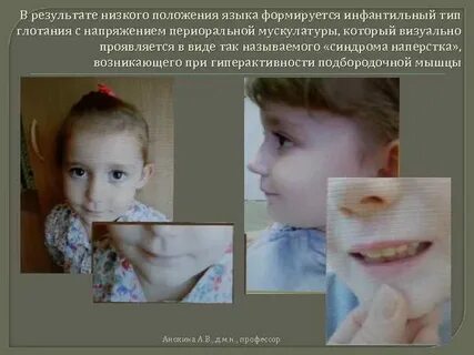 Инфантильный тип глотания