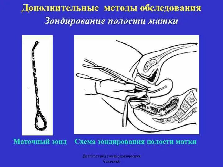 Биопсия выскабливанием. Зондирование полости матки инструменты. Выскабливание полости матки инструментарий диагностическое. Алгоритм проведения зондирования полости матки. Зондирование матки в гинекологии.