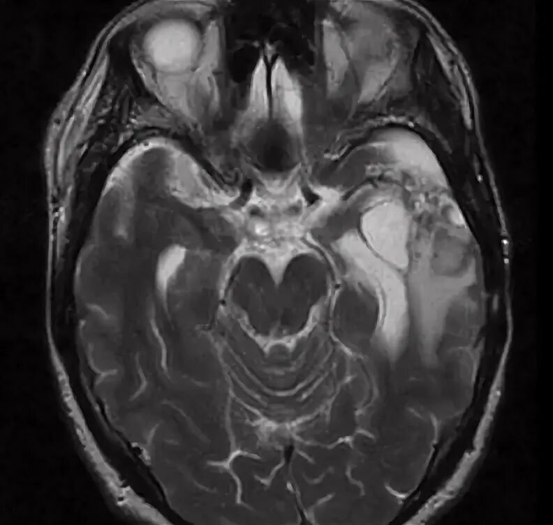 Глиоз мозга последствия. Глиоз на мрт. Глиоз мозга. Глиоз головного мозга кт. Астроцитома 4 Grey.