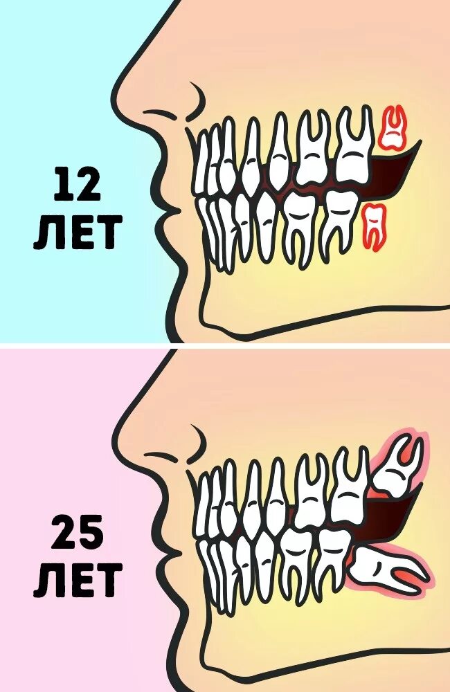 Куда зубы дел. Удаленные зубы мудрости.