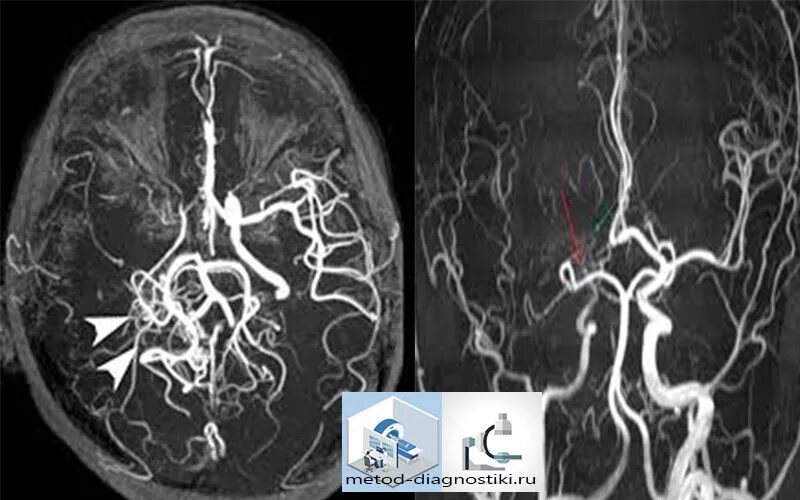 Мрт сосудов головного мозга (мрт-ангиография). Кт ангиография сосудов головного мозга. Мрт ангиография сосудов головного мозга. Кт ангиография сосудов шеи аневризма. Мрт головы тамбов
