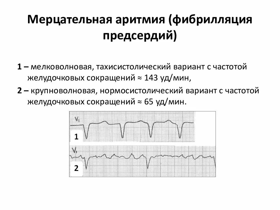 Крупноволновая фибрилляция предсердий на ЭКГ. Мерцательная аритмия и фибрилляция предсердий. Пароксизмальная фибрилляция предсердий на ЭКГ. Фибрилляция предсердий крупноволновая форма. Формы трепетания предсердий