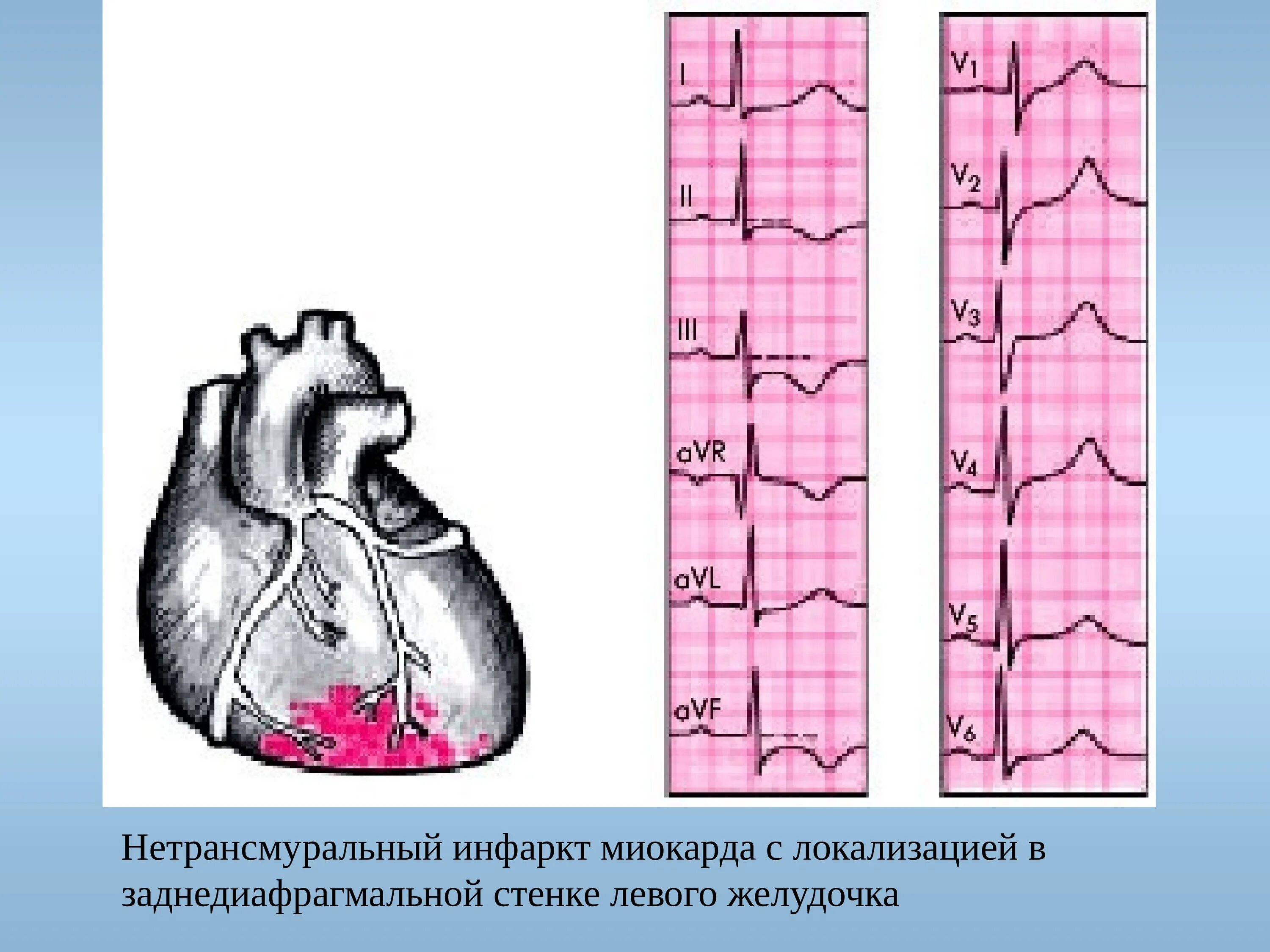 Изменения в нижней стенке левого желудочка. Острый Нижний (заднедиафрагмальный) инфаркт миокарда. Острый инфаркт миокарда задней стенки. Инфаркт миокарда нижней стенки лж. Острый задне-Нижний инфаркт миокарда.