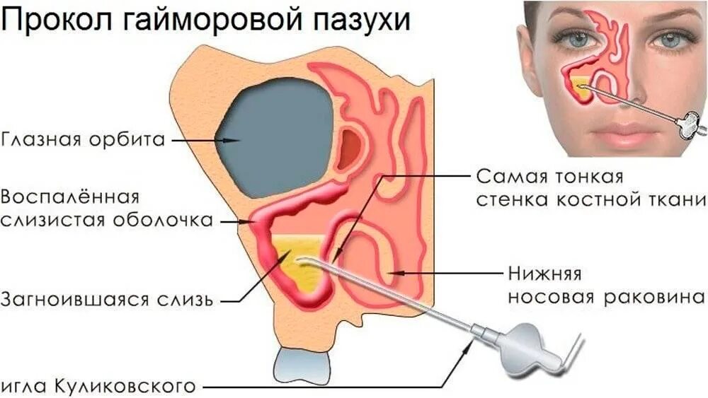 Может ли гайморит перейти в менингит. Пункция гайморовой пазухи операция. диагностическая пункция гайморовой пазухи. гайморит прокол гайморовой пазухи. что такое пункция верхнечелюстных пазух носа.