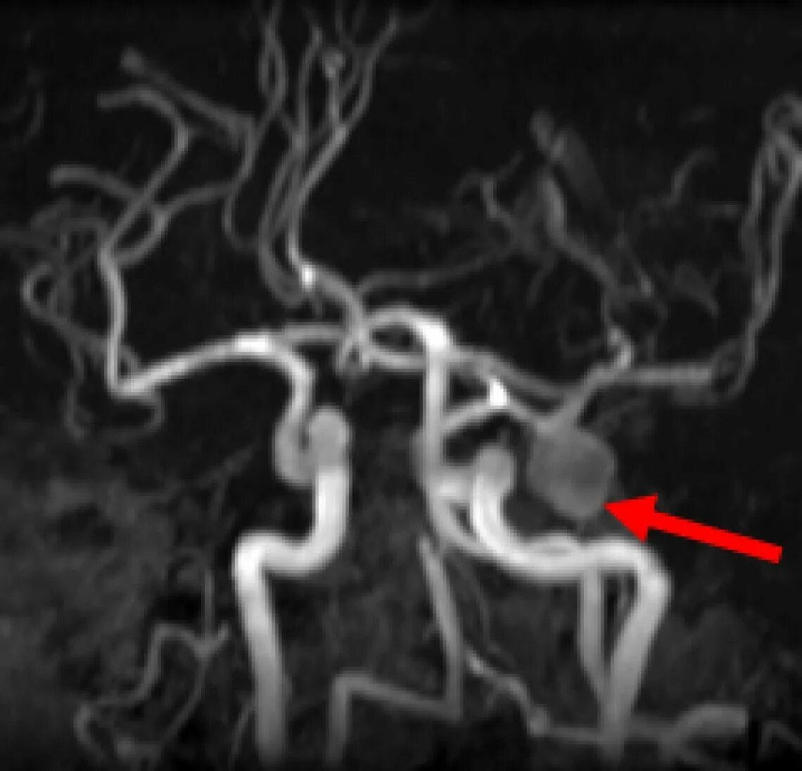 Сосуды головного мозга норма. Бесконтрастная магнитно-резонансная ангиография. Кт ангиография аневризма. Аневризма артерии мозга мрт.