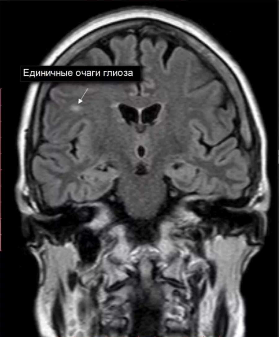 Мр картина очагов глиоза