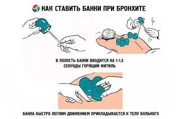 Можно ли ставить банки при температуре 38. Схема постановки банок. схема постановки медицинских банок при бронхите. схема постановки банок на спину. как правильно поставить банки на спину.