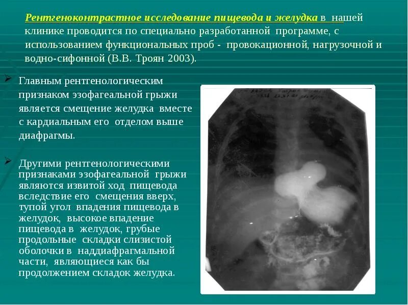 Водно сифонная проба желудка. УЗИ С водно-сифонной пробой у детей. Сифонная проба у ребенка УЗИ. Диафрагмальная грыжа на УЗИ.