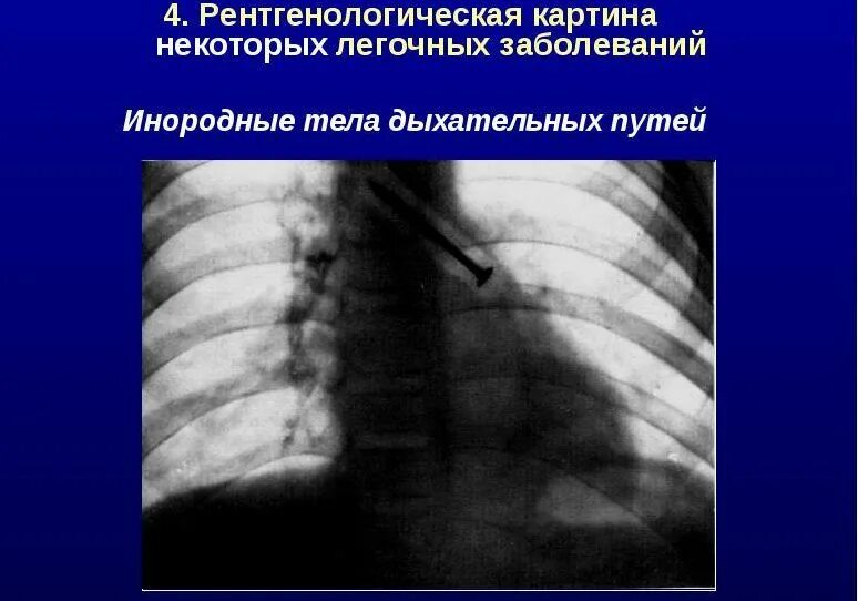 Инородные Тела Трахеи Бронхов