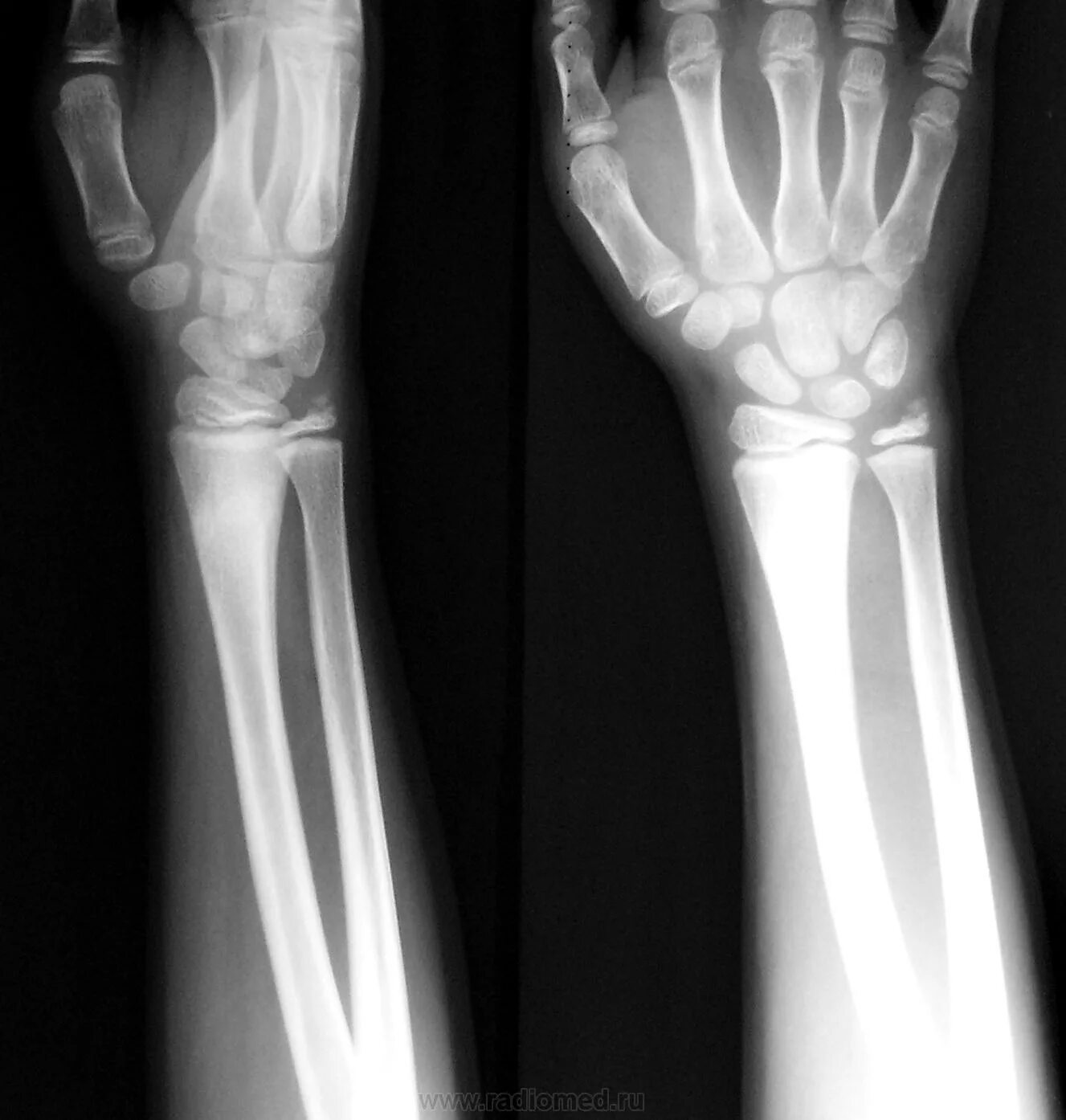 Рентген перелома кости предплечья. Перелом 3 локтевой кости руки. Перелом лучезапястного сустава рентген. Лучевая и локтевая кости на рентгене.