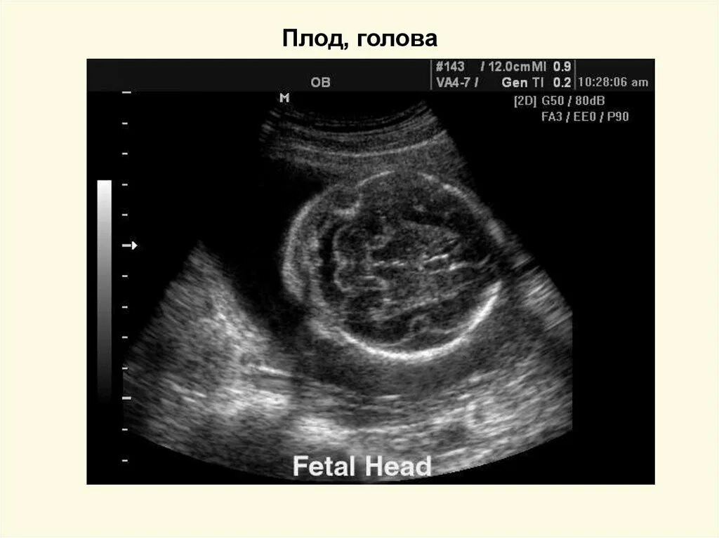 Узи мать и дитя. Узи мать и дитя. Большая цистерна мозга у плода. Большая цистерна мозга у плода. Хиазмальная цистерна расширена.