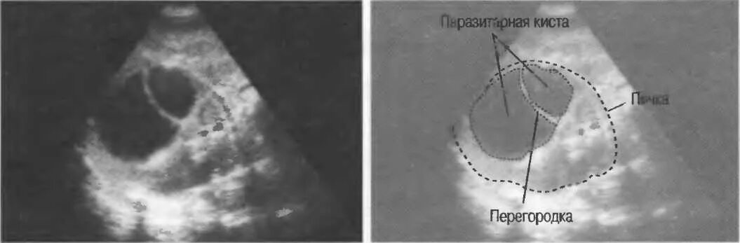 Киста почки с перегородками УЗИ. Киста яичника с перегородкой на УЗИ.