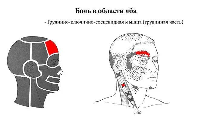 Область лба. Болит левая сторона головы. Боль в левой части головы над ухом.