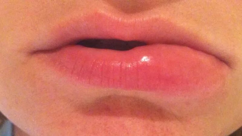 Форма половых губ персик щавель фото. Аллергический отек губ. Аллергическая реакция на губах. Аллергическая сыпь на губах.