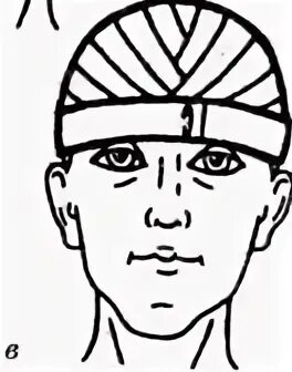 Техника наложения мягких повязок. Крестообразная повязка на затылок.