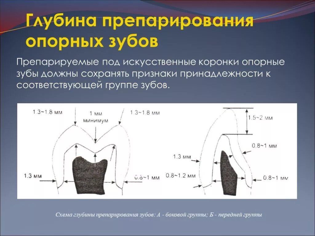 Препарирование зуба под металлическую коронку. Этапы препарирования зуба под металлокерамическую коронку. препарирование зуба под металлокерамическую коронку схема.