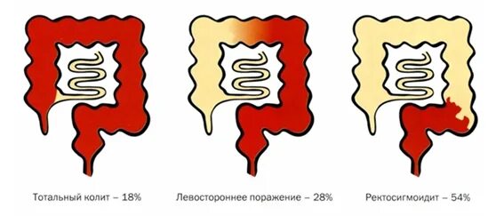 Спастический язвенный колит хронический. Профилактика колита у детей. Ведущий симптом при синдроме раздраженной толстой кишки:. Спастический колит форум. Синдром золлингера-эллисона.