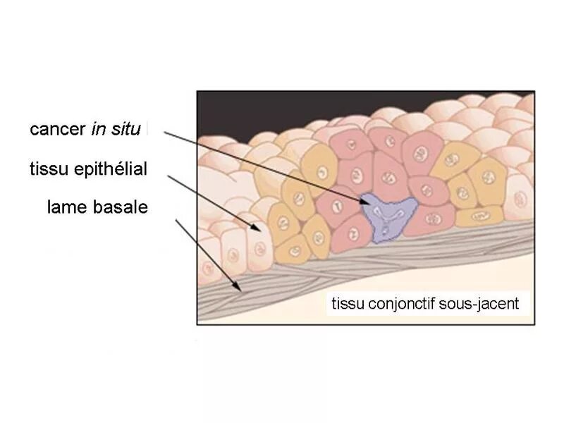 Карцинома in situ локализация. Рак in situ шейки