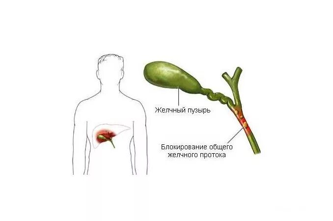 Желчный пузырь простыми словами. Дискинезия желчевыводящих путей и пузыря. Дискинезия желчных путей. Дискинезия желчного пузыря. Дискинезия желчного пузыря и желчных путей..