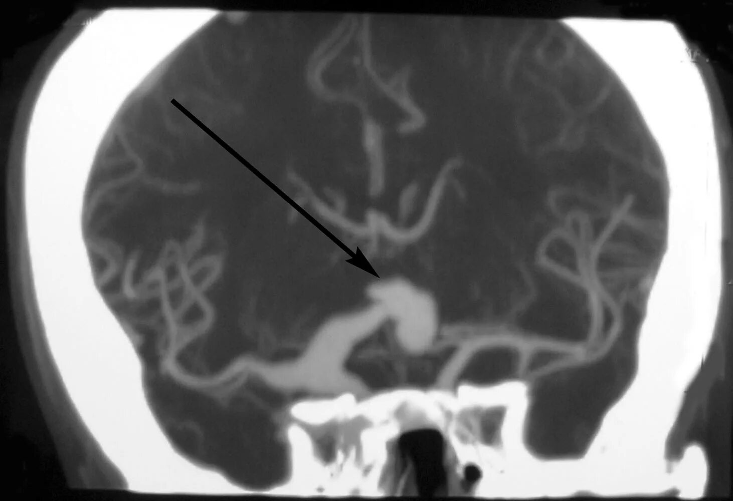 Форум аневризма мозга. Аневризма сосудов головного мозга кт. Аневризма сосудов головного мозга кт ангиография. Фузиформная аневризма кт. Аневризма головного мозга на кт.