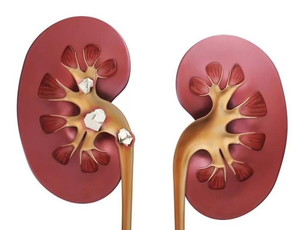 Коралловидный нефролитиаз. Мочекаменная болезнь почек. Мочекаменная и Почечнокаменная болезнь.