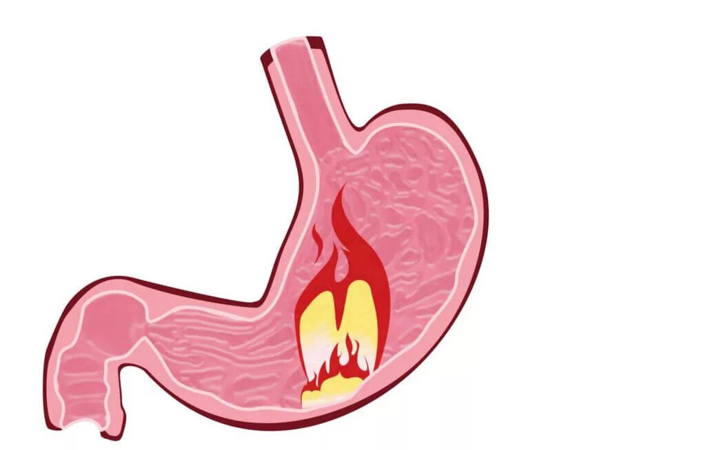 Хронический гастрит изжога