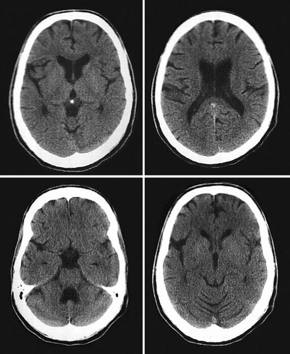 Кт томограмма головного мозга. Компьютерная томография кт головного мозга. Рентгеновская компьютерная томография головного мозга. Компьютерная томография головного мозга норма.