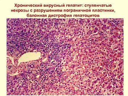 Хроническая дистрофия печени