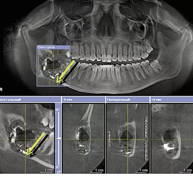 Снимок будут делать. Киста нижней челюсти снимок. Рентген верхней и нижней челюсти. Остеомиелит челюсти компьютерная томография.