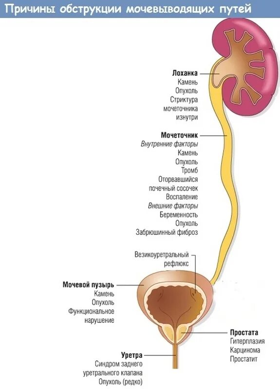 Как болят мочеточники симптомы. Обструкция мочевого пузыря. Конкремент нижней 3 мочеточника. 1/3 Мочеточника. Почки мочеточник выход камней.