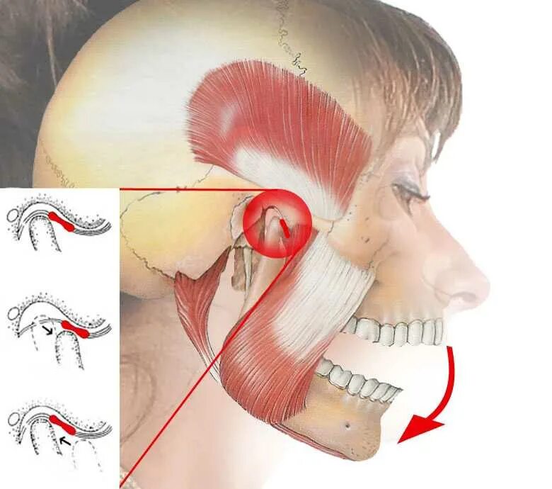 Мышечная дисфункция ВНЧС. Дисфункция височно-нижнечелюстного сустава (ВНЧС). Болит голова и щека