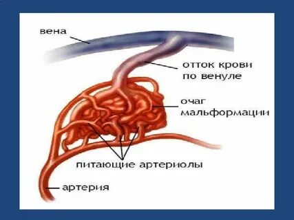 Сосудистая аномалия