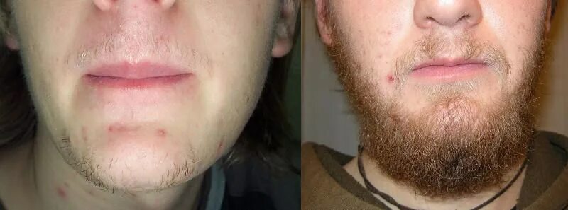 Почему появляется борода. Миноксидил борода до и после. Миноксидил 5 для бороды. Миноксидил для волос для мужчин для бороды. Кожа после бритья миноксидил.