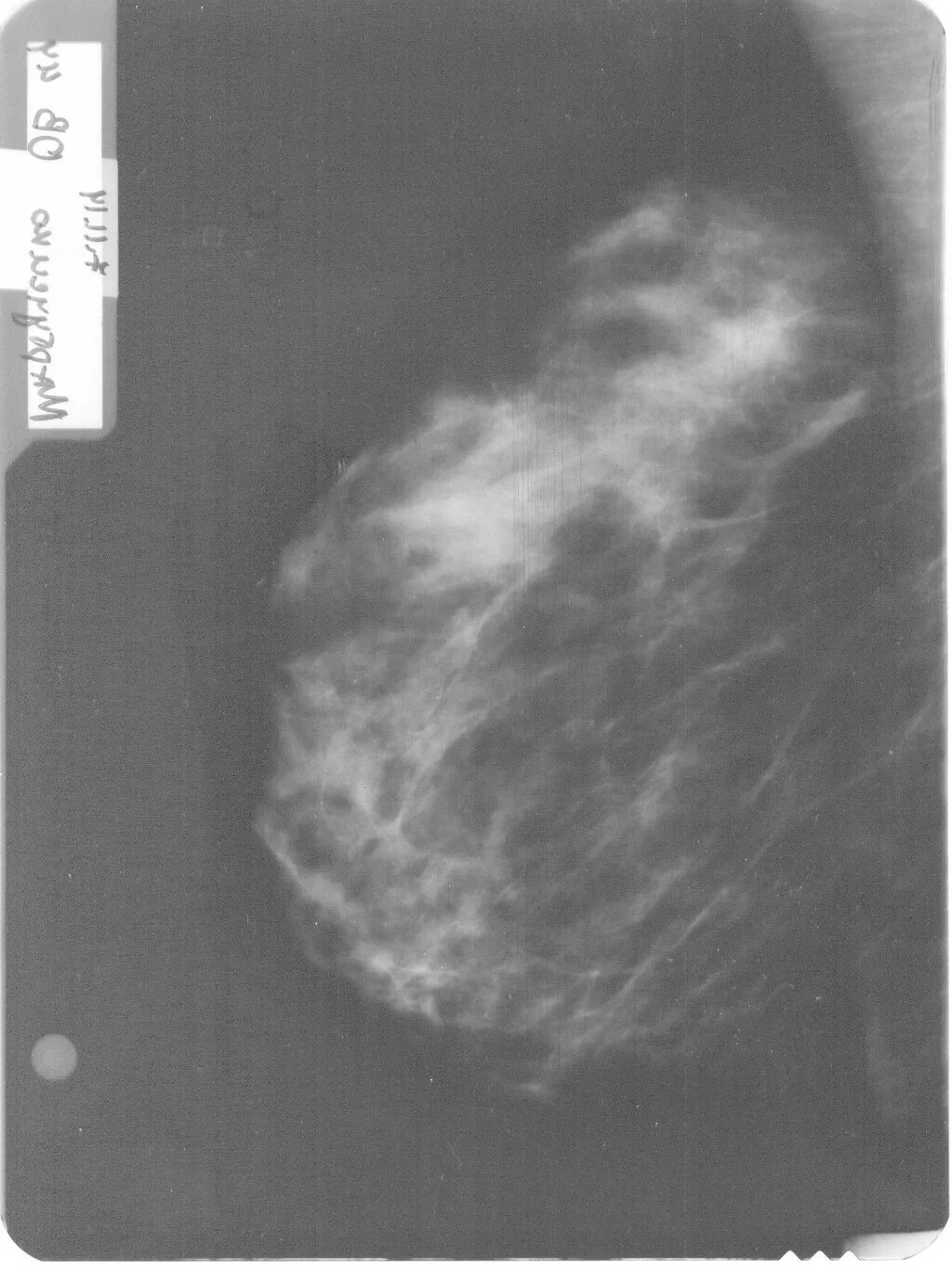 Маммография старый. Маммография м0м1д. Маммография снимок в норме. Маммография расшифровка снимков. Овальная тень на маммографии.