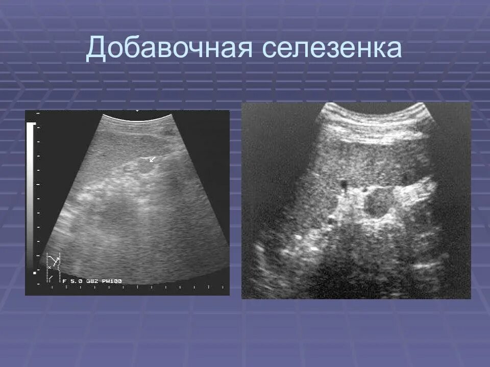 Добавочная долька селезенки на УЗИ. Дольчатая селезенка на кт. Дополнительная долька селезенки у ребенка.