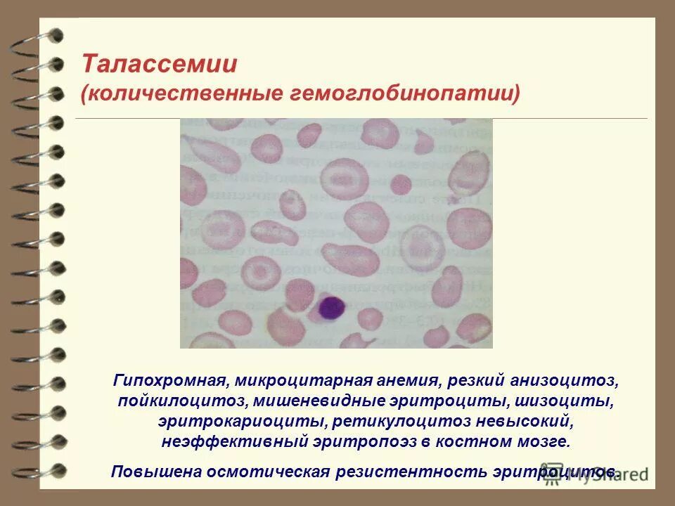 железодефицитная анемия анизоцитоз пойкилоцитоз. пойкилоцитоз эритроцитов. анизоцитоз пойкилоцитоз анизохромия. пойкилоцитоз анизоцитоз анемия. анизоцитоз пойкилоцитоз полихроматофилия.