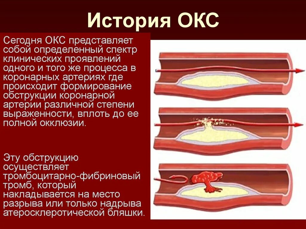 Коронарные осложнения. Острый коронарный синдром. Острый коронарный синдром (Окс). Острый коронарный синдром патогенез. Клинические проявления Окс.