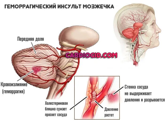 Кровоизлияние в мозжечок. Геморрагический инсульт мозжечка. Инсульт мозжечка кт. Ишемический инсульт в мозжечке на кт. Кровоизлияние в мозжечок.