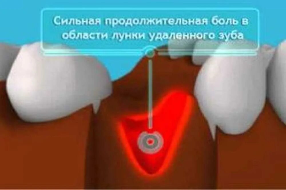 Как отличить зубную боль от воспаления. Альвеолит лунки зуба мудрости. Альвеолит воспаление лунки.