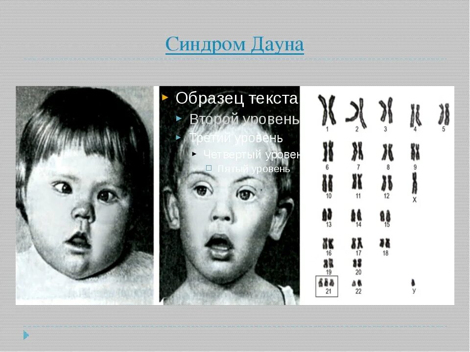 Болезнь дауна является. Синдром Дауна схема хромосом. Болезнь Дауна кариотип. Синдром Дауна карта хромосом. Синдром Дауна трисомия.