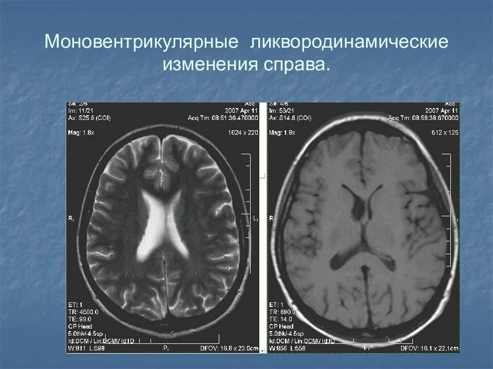 Гидроцефалия головного мозга на кт. Внутренняя гидроцефалия на кт головного мозга. Ликвородинамические нарушения головного мозга на мрт. Гидроцефалия головного мозга мрт.