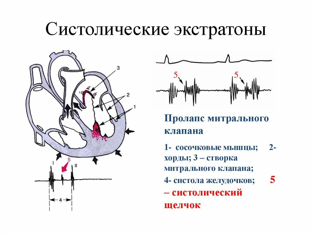 Прогиб створок митрального клапана. Пролапс передней створки митрального клапана. пролапс створок митрального клапана. пролапс митрального клапана 1 степени на экг. удлинение хорд митрального клапана на узи сердца.