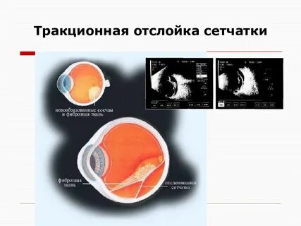 Отслойка сетчатки клинические рекомендации
