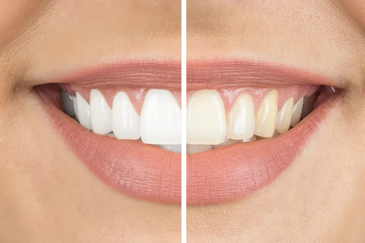 Отбеливание зубов. Отбеленные зубы красивые. Красивые белые зубы.