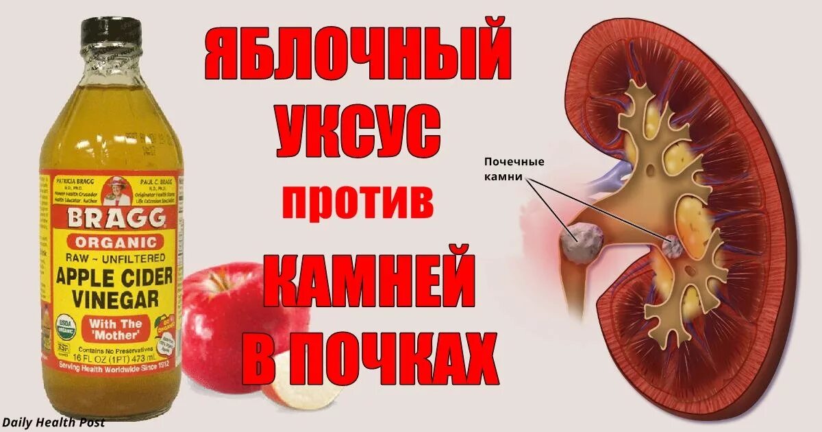 При камнях в почках какую воду пить. Лекарство для выведения камней из почек. Средство для растворения камней в почках. Растворение почечных камней препараты.