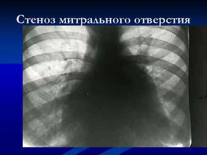 Врожденный стеноз трахеи. Легочный рисунок усилен. Стеноз легких. Митральный стеноз рентгенограмма. Изолированный стеноз легочной артерии рентген.